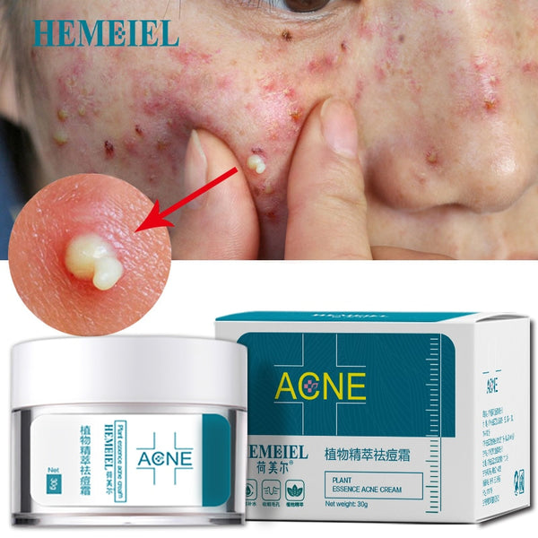 HEMEIEL Acne Treatment Face Cream Anti Acne Scar Removal Pimple Blackhead Moisturizing Whiten Oil-control Shrink Pores Skin Care